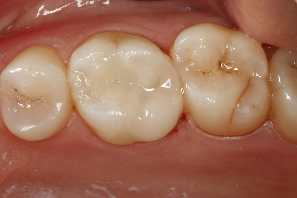 After - Moorside Dental