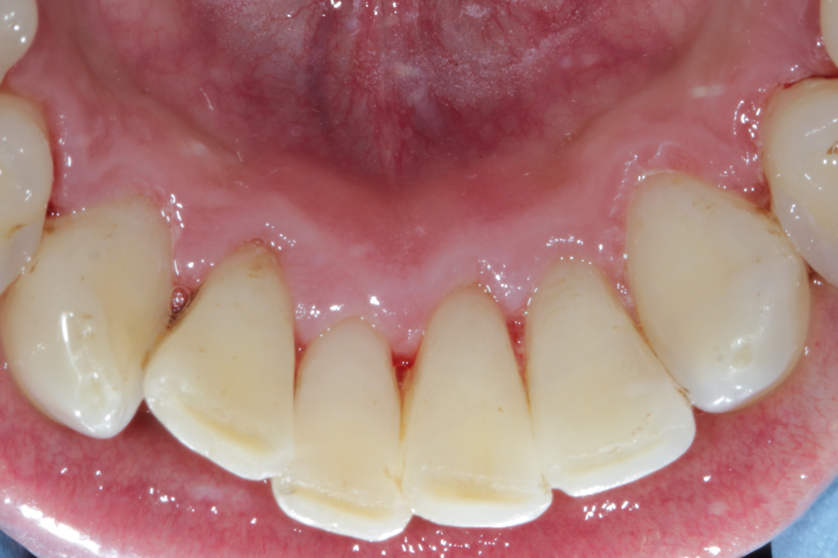 After - Moorside Dental