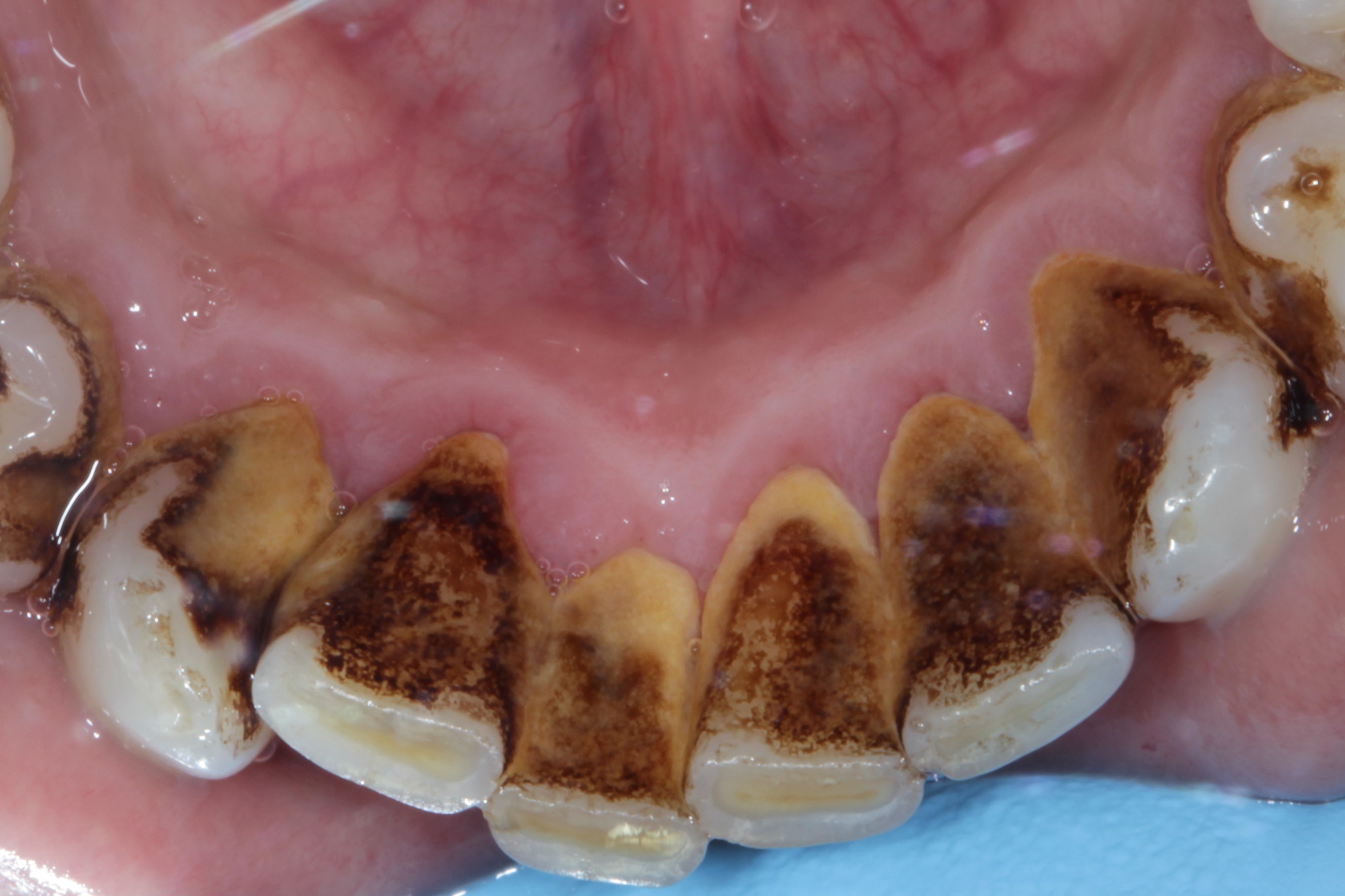 Before - Moorside Dental
